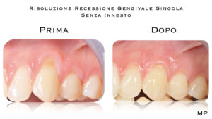 Dr Massimo Pedrinazzi - esempio di caso trattato