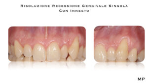 Dr Massimo Pedrinazzi - esempio di caso trattato