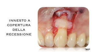 Dr Massimo Pedrinazzi - esempio di caso trattato