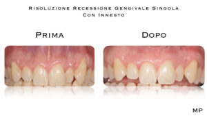 Dr Massimo Pedrinazzi - esempio di caso trattato
