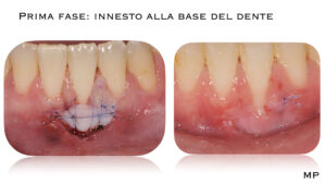 Dr Massimo Pedrinazzi - esempio di caso trattato