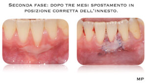 Dr Massimo Pedrinazzi - esempio di caso trattato