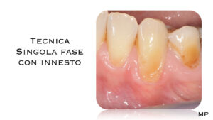 Dr Massimo Pedrinazzi - esempio di caso trattato