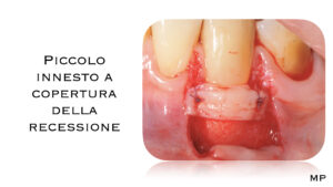 Dr Massimo Pedrinazzi - esempio di caso trattato