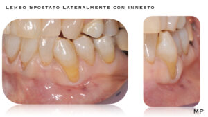 Dr Massimo Pedrinazzi - esempio di caso trattato