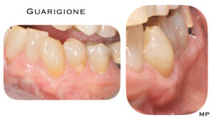 Dr Massimo Pedrinazzi - esempio di caso trattato