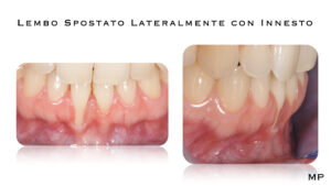 Dr Massimo Pedrinazzi - esempio di caso trattato