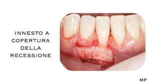 Dr Massimo Pedrinazzi - esempio di caso trattato