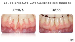 Dr Massimo Pedrinazzi - esempio di caso trattato