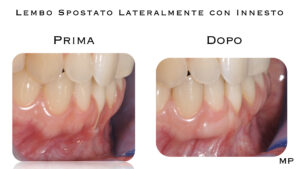 Dr Massimo Pedrinazzi - esempio di caso trattato