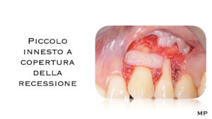 Dr Massimo Pedrinazzi - esempio di caso trattato