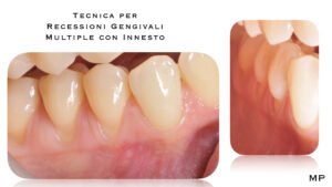 Dr Massimo Pedrinazzi - esempio di caso trattato