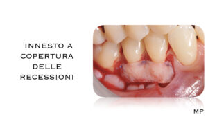 Dr Massimo Pedrinazzi - esempio di caso trattato