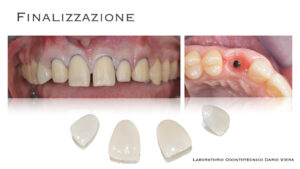 Dr Massimo Pedrinazzi - esempio di caso trattato