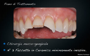 Dr Massimo Pedrinazzi - esempio di caso trattato