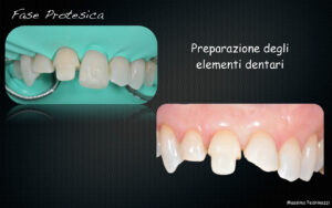 Dr Massimo Pedrinazzi - esempio di caso trattato