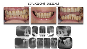 Dr Massimo Pedrinazzi - esempio di caso trattato